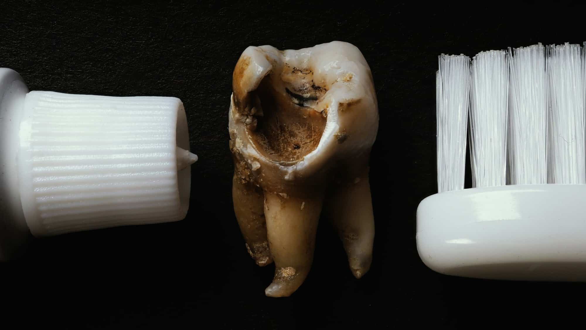 Comment prévenir les caries dentaires ?