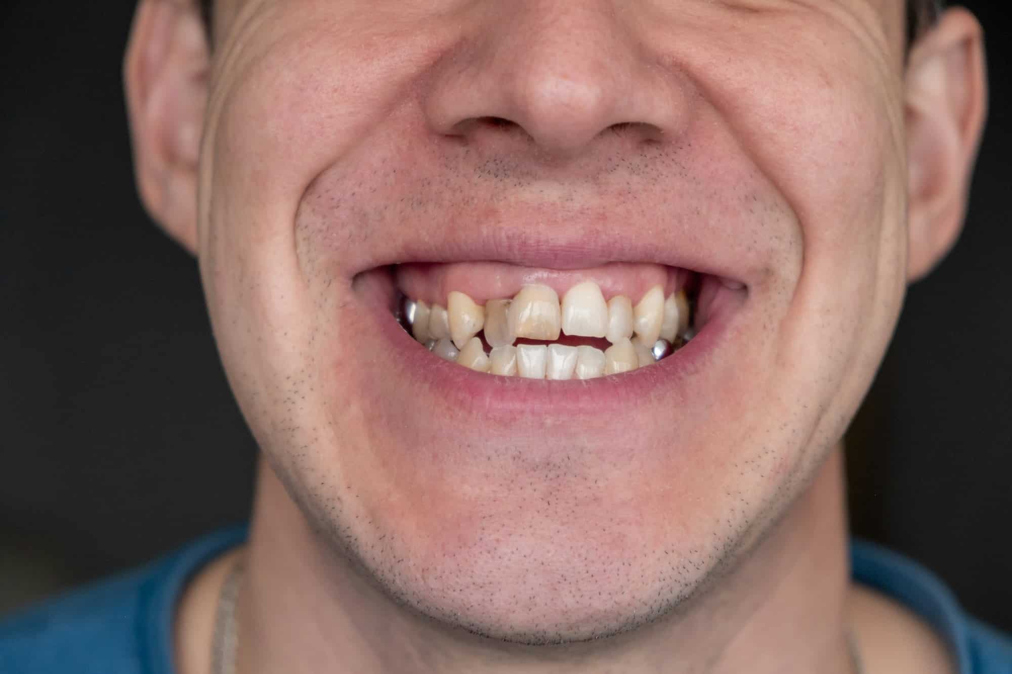 Quels sont les symptômes d’une infection dentaire ?